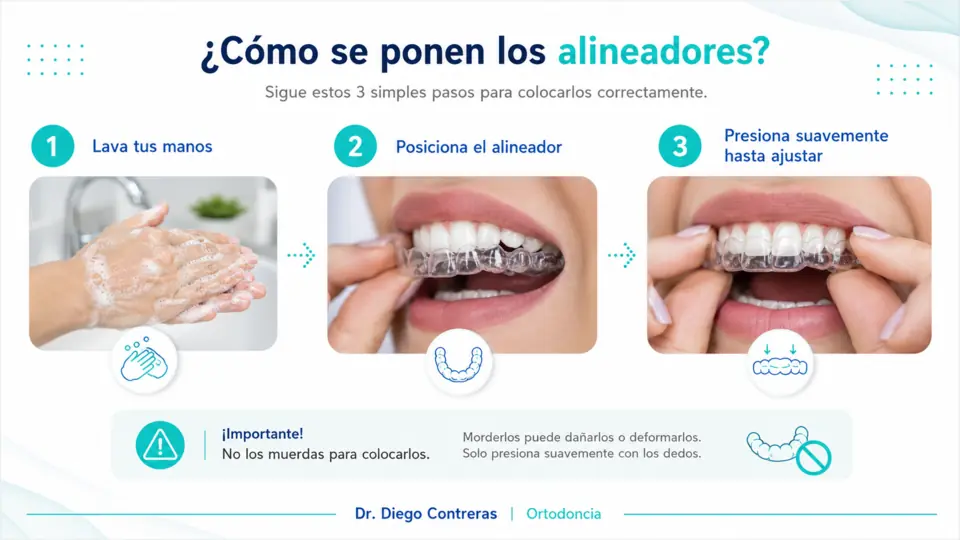 Guía en tres pasos para colocar correctamente los alineadores