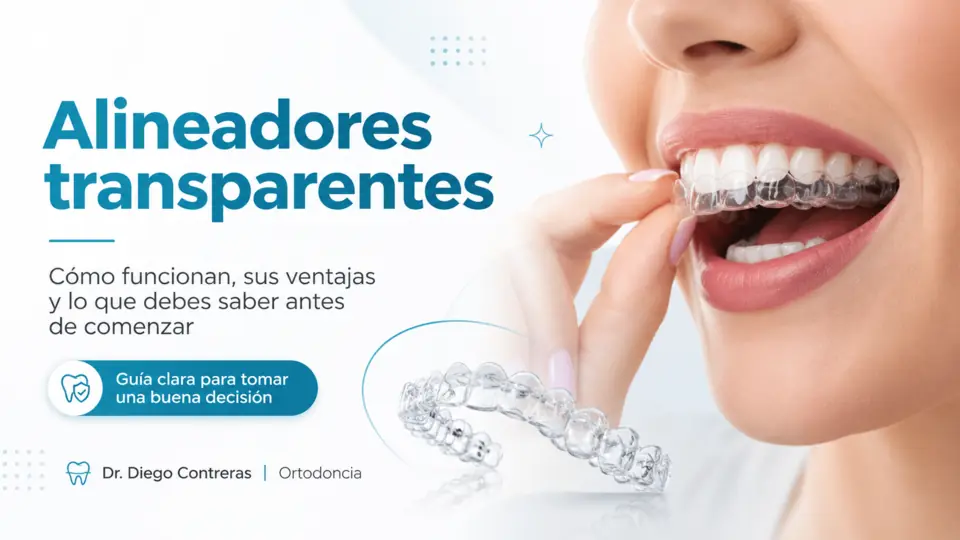 Persona colocando un alineador dental transparente