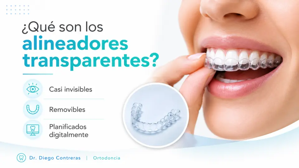 Explicación visual de qué son los alineadores transparentes