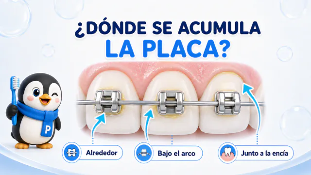 Zonas donde puede acumularse placa alrededor de los brackets, bajo el arco y junto a la encía