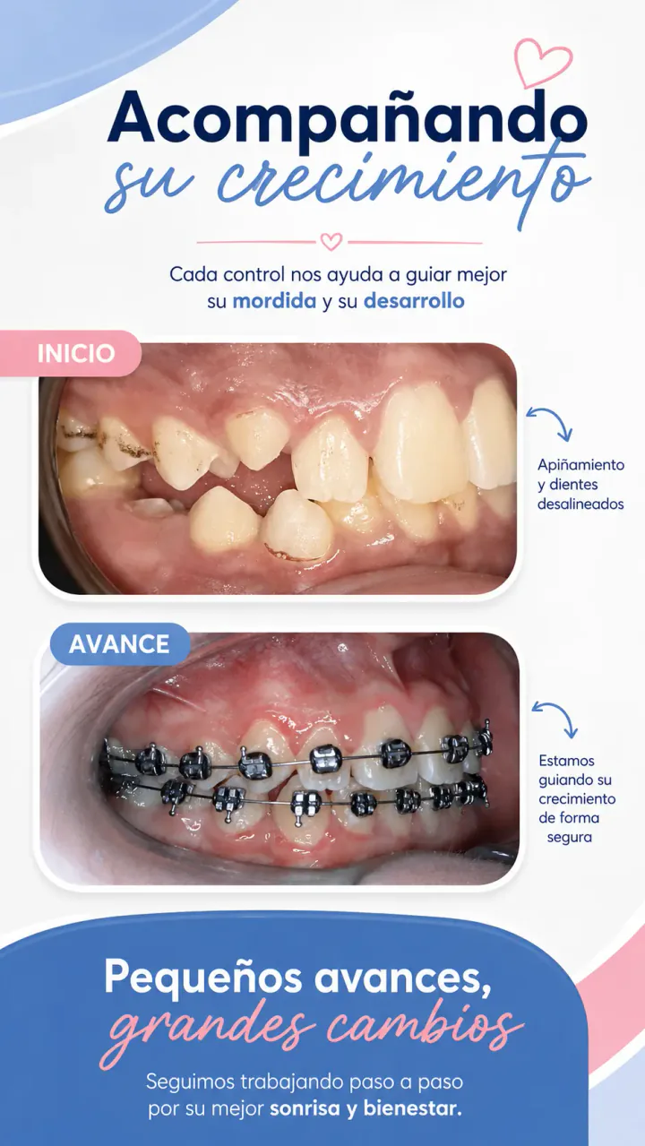 Avance de ortodoncia durante el crecimiento
