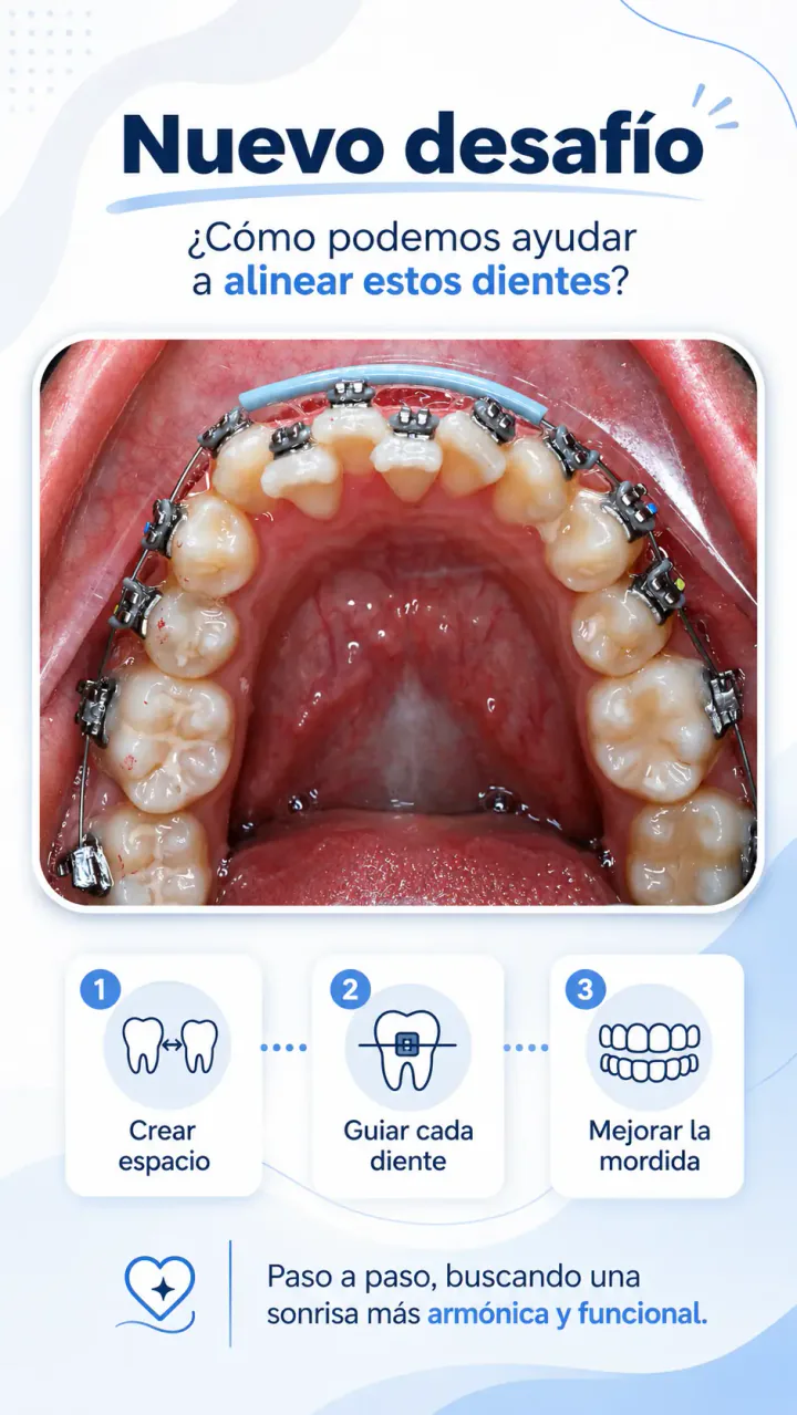 Registro oclusal de un nuevo desafío de alineación dental
