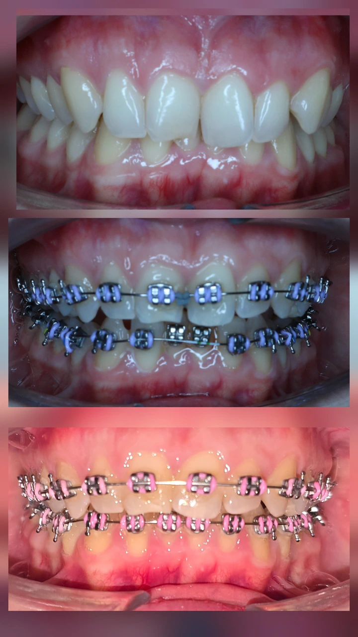 Registros fotográficos en tres etapas del tratamiento de ortodoncia
