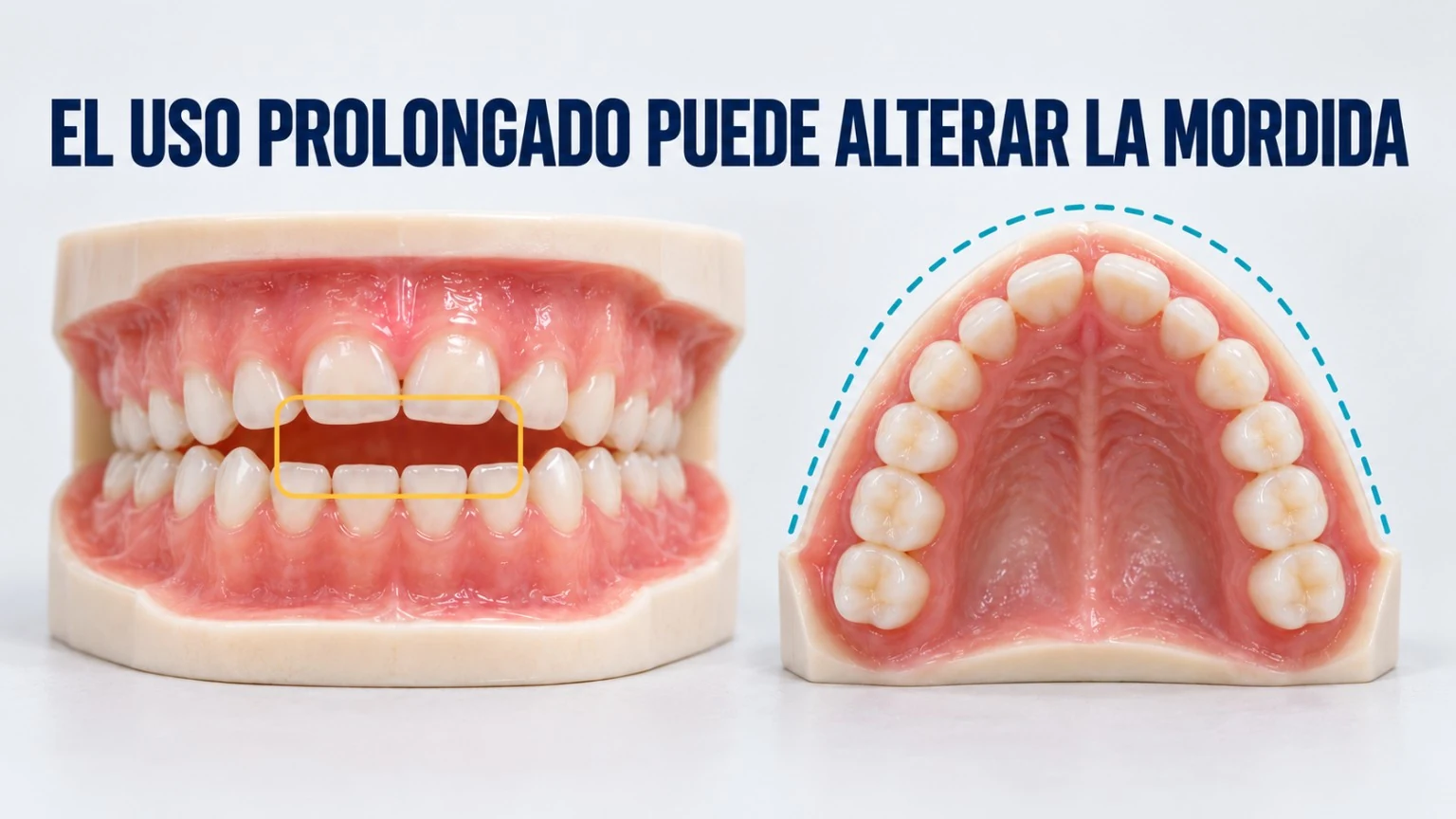 Modelo ilustrativo con separación entre los dientes anteriores y una vista del arco superior
