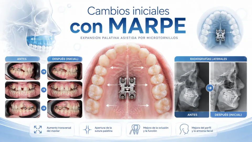 Representación de cambios iniciales durante expansión maxilar asistida por microtornillos