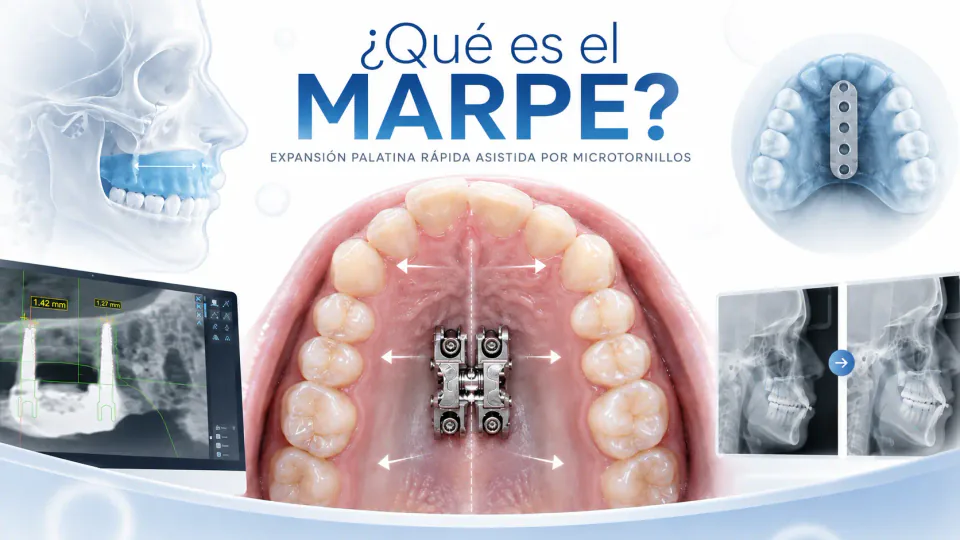 Ilustración educativa de expansión palatina rápida asistida por microtornillos