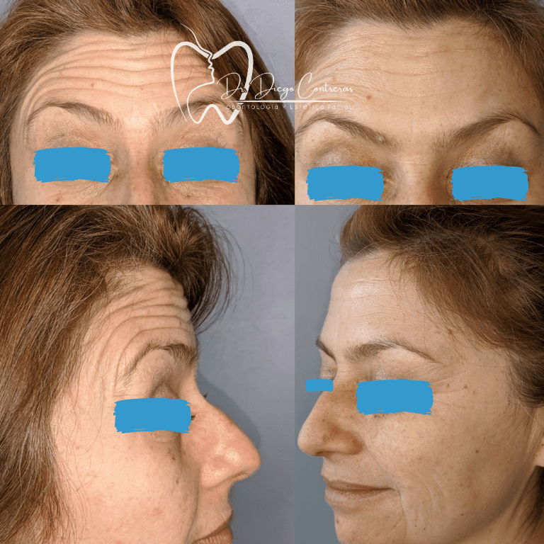 antes y despues botox